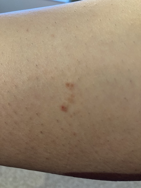 Worrying mole? Pic included