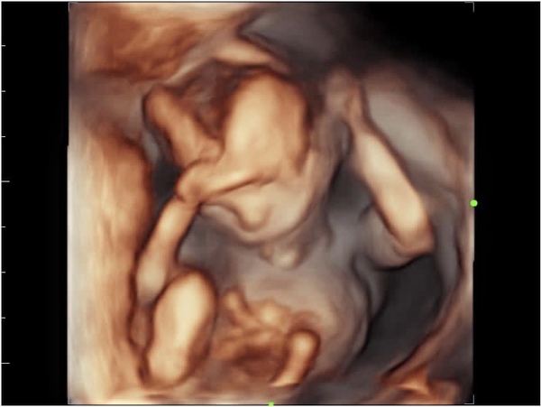 Do you want me to guess the sex? 12 week scans.
