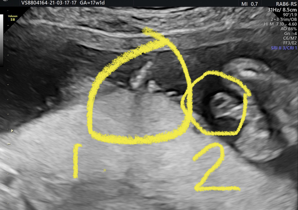 Gender Help !!!