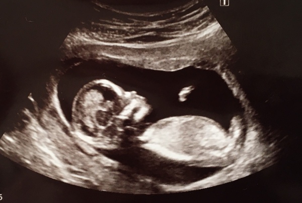 Do you want me to guess the sex? 12 week scans.