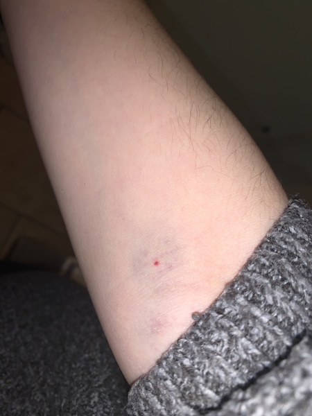Red spot at blood test site?