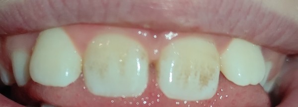 AIBU to feel cheated about DD's teeth? (Pic included)