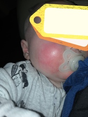 Nutramigen and CMPA, when does it work? :(