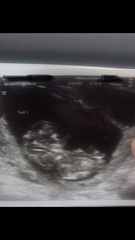 Pregnancy after loss - Autumn babies 2021 - Thread 2