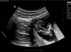 Boy or Girl