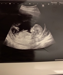 Guess the gender- 13 week 5 day scan cheer me up!
