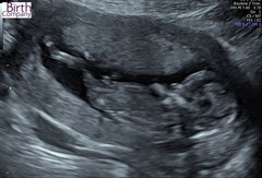 Sorry....another ‘guess the gender’ - 13+4 scan
