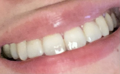 Invisalign