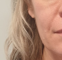 Anyone had fillers for jowls and dare to share before and after pics?