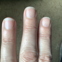Could this be the start of osteoporosis?