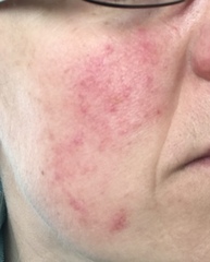 Best cleanser for rosacea sufferer