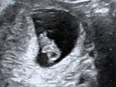 Pregnancy after loss - Autumn babies 2021 - Thread 2