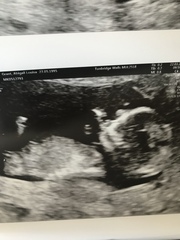 Nub and skull theory 13 weeks scan!