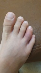 My dd (12) has covid toe!