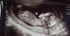 Boy or girl? 13 week scan!☺️