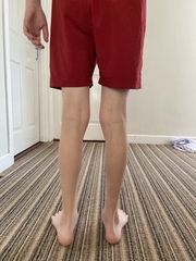 Knock knee
