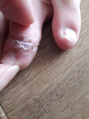My dd (12) has covid toe!