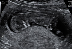 Another Nub Thread! 12 Week Scan