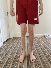 Knock knee