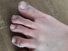 My dd (12) has covid toe!