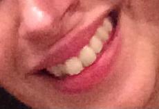 Invisalign