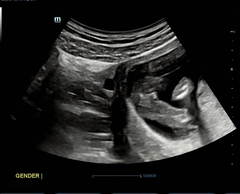 Boy or Girl