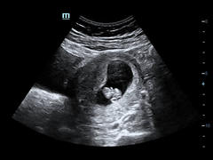 Pregnancy after loss - Autumn babies 2021 - Thread 2