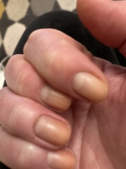 What is wrong with my nail (horrible photos)?