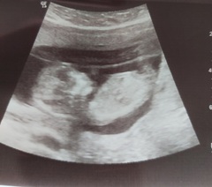 Gender guess at 13 weeks