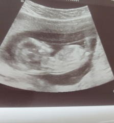 Gender guess at 13 weeks
