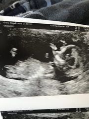 Nub and skull theory 13 weeks scan!