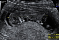 Another Nub Thread! 12 Week Scan