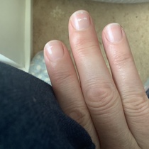 Could this be the start of osteoporosis?