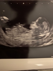 Guess the gender- 13 week 5 day scan cheer me up!