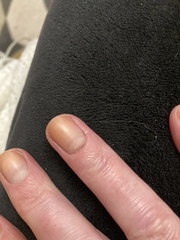 What is wrong with my nail (horrible photos)?