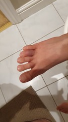 My dd (12) has covid toe!