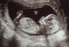 Boy or girl? 13 week scan!☺️