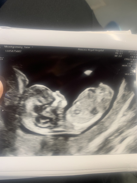 Do you want me to guess the sex? 12 week scans.