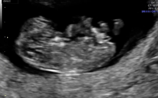 10 week scan - concern