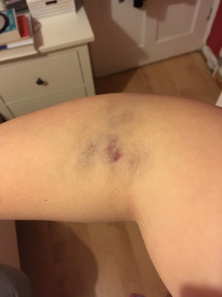 Bruise after blood test (pic attached)