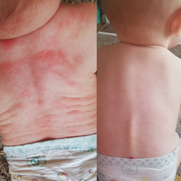 Possible cows milk allergy