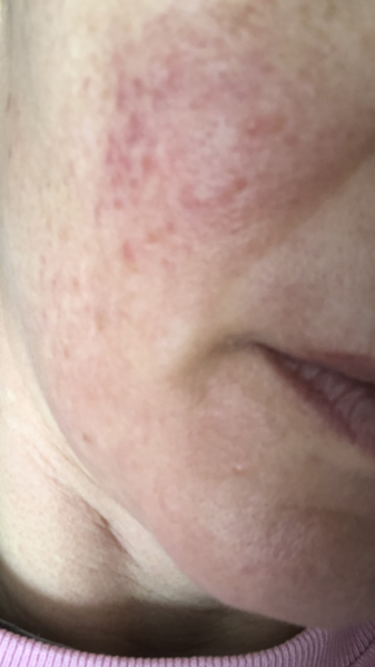 Rosacea. What works and what doesn't.
