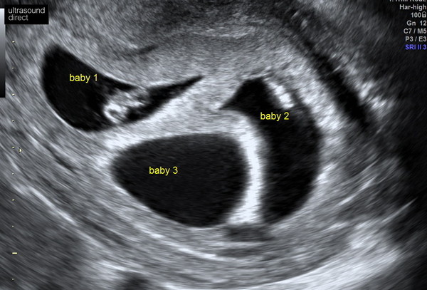 Due November 2021 - thread 2!
