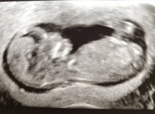 Thyroid function in pregnancy - normal?