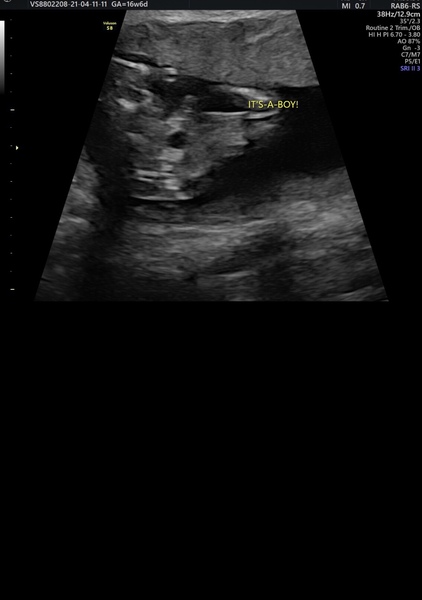POTTY SHOT 15 weeks 4 days?
