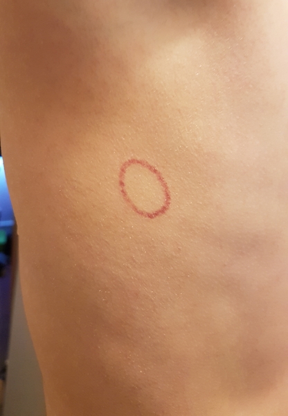 Anyone fancy diagnosing this thing on my child's skin?
