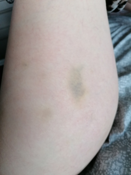 Do these bruises look worrying to you?