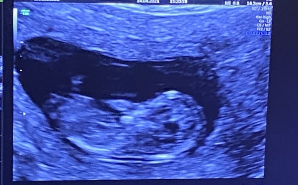 Gender 12 weeks