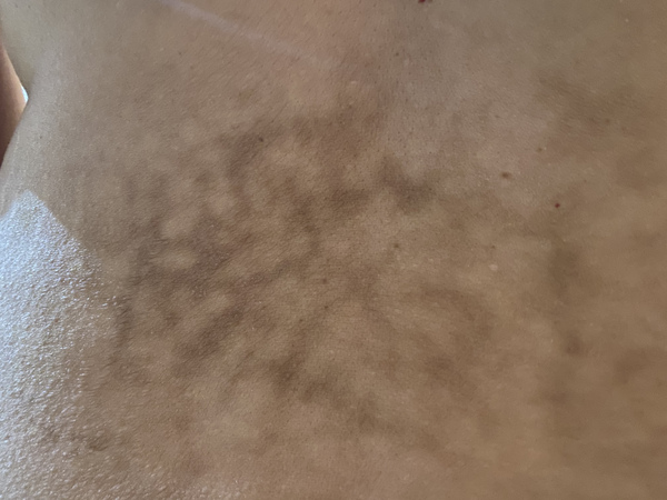 Weird bruise rash 2 weeks after first AZ vacinne