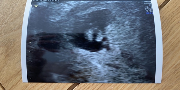 7 week scan picture
